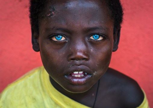 Ethiopian boy called abushe with blue eyes suffering from waardenburg syndrome, Omo valley, Jinka, Ethiopia