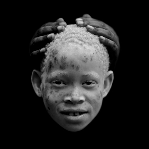 Zamda, Albino girl in mikindani, Tanzania