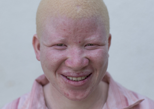 Tanzania, East Africa, Dar es Salaam, jenipher stanford a teen with albinism at under the same sun house