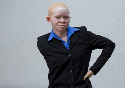 Tanzania, East Africa, Dar es Salaam, miss kabula ngarango a girl with albinism at under the same sun house, her right
arm was  hacked off by men