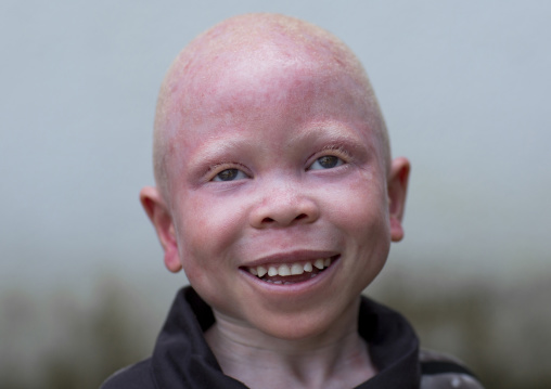 Tanzania, East Africa, Dar es Salaam, baraka cosmas a boy with albinism at under the same sun house, he lost his right hand in a witchcraft attack