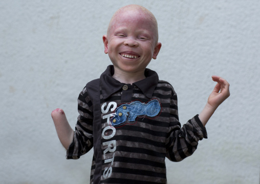 Tanzania, East Africa, Dar es Salaam, baraka cosmas a boy with albinism at under the same sun house, he lost his right hand in a witchcraft attack