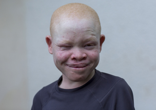 Tanzania, East Africa, Dar es Salaam, emmanuel festo a boy with albinism at under the same sun house, his left arm
was hacked off above the elbow, he lost fingers on the right hand and his to