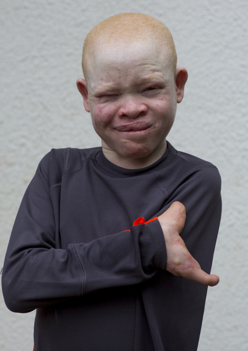 Tanzania, East Africa, Dar es Salaam, emmanuel festo a boy with albinism at under the same sun house, his left arm
was hacked off above the elbow, he lost fingers on the right hand and his to