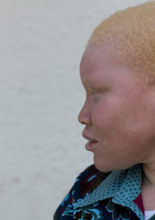 Tanzania, East Africa, Dar es Salaam, kulwa lusana a girl with albinism at under the same sun house, she lost one hand