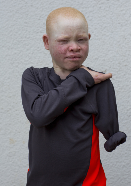 Tanzania, East Africa, Dar es Salaam, emmanuel festo a boy with albinism at under the same sun house, his left arm
was hacked off above the elbow, he lost fingers on the right hand and his to