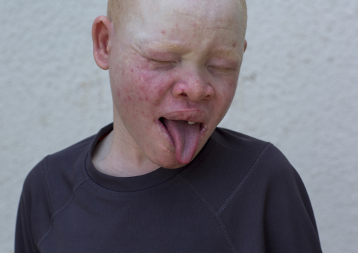 Tanzania, East Africa, Dar es Salaam, emmanuel festo a boy with albinism at under the same sun house, his left arm
was hacked off above the elbow, he lost fingers on the right hand and his to